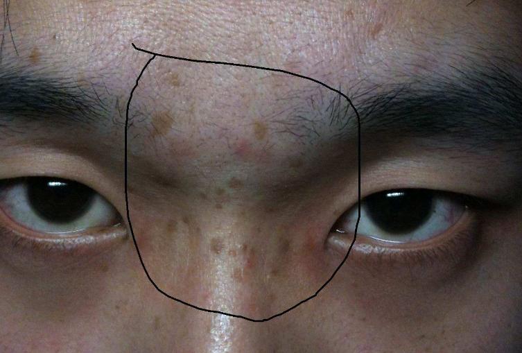 背部爆痘用什么药,背部长痘原因以及怎么调理