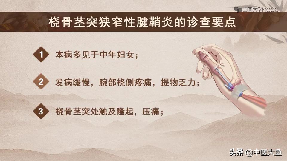 桡骨茎突狭窄性腱鞘炎怎么治疗,桡骨茎突狭窄性腱鞘炎治疗方法