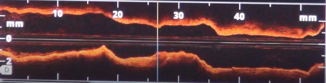 血管狭窄50需要支架吗,血管50%狭窄要长期吃药吗