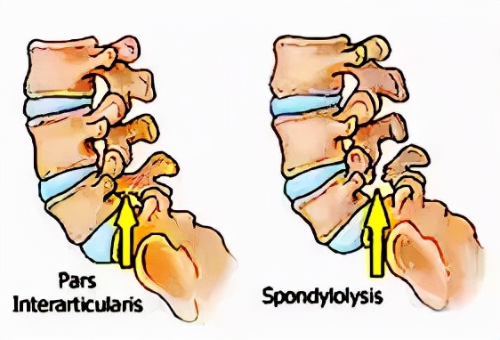 青少年脊柱弯曲危害科普视频,脊柱病科普小常识大全