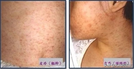 孩子热疹有什么好办法,反复发热有没有可能是幼儿急疹