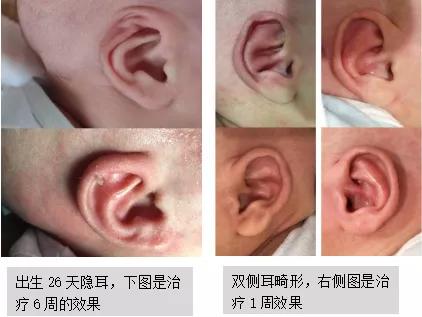 宝宝耳廓形态畸形怎么办,新生儿耳廓畸形治疗费用