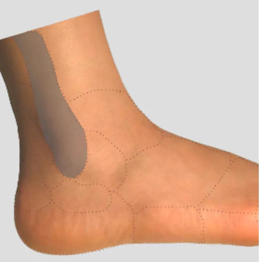 足踝各种疼痛的原因,足踝内侧疼痛自测