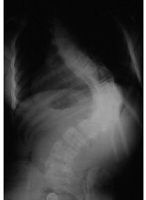 轻度脊柱侧弯医生不建议矫正,s型脊柱侧弯医生能通过手法纠正