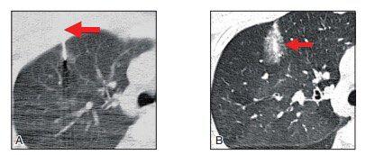 肺结节中的ggo代表什么,肺结节ggn与ggo有什么区别