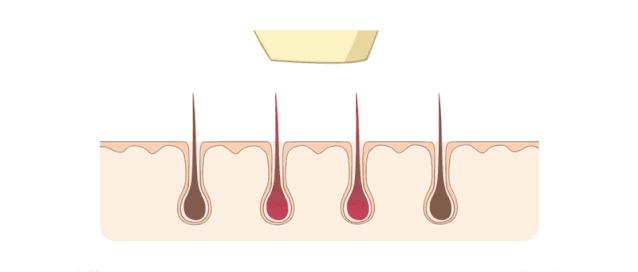 脱毛膏和激光脱毛哪个好,激光脱毛和脱毛膏