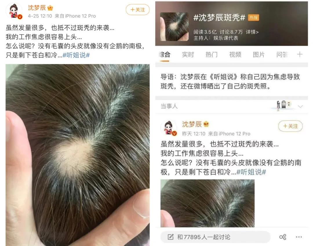 沈梦辰脱发是什么原因,沈梦辰工作焦虑导致斑秃