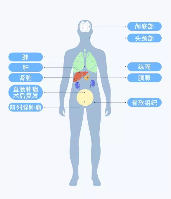 质子治癌细胞靠谱吗,质子治疗能彻底治愈癌症吗