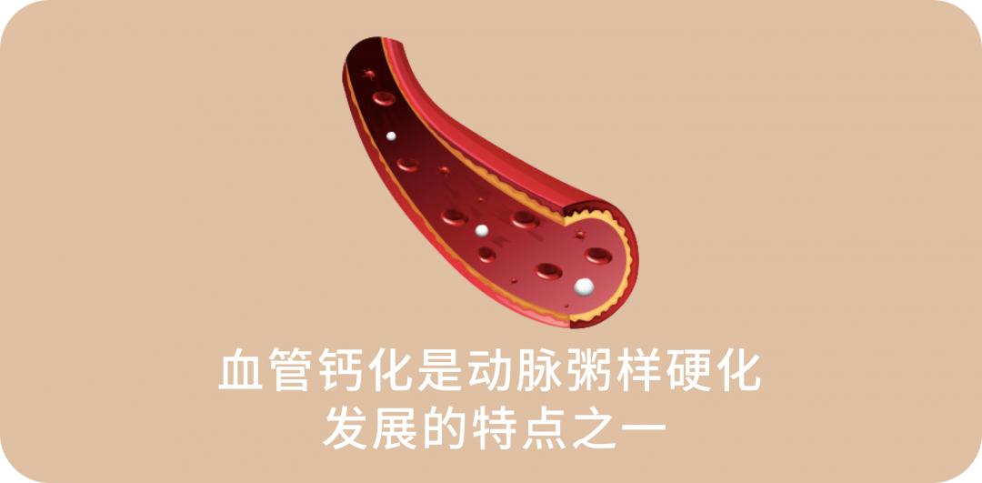 血管钙化是补钙多引起的吗,补钙过多导致血管钙化治疗方法