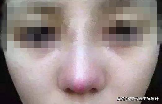 红色预警发出后规定的防范措施,哪些鼻型不适合线雕隆鼻