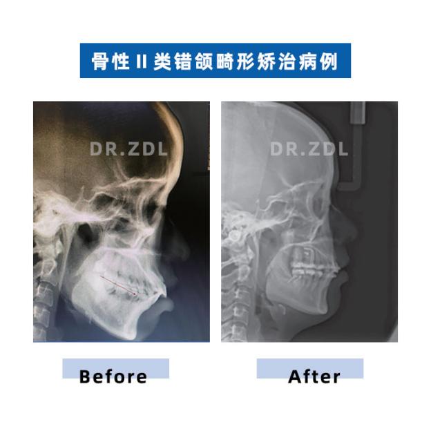 骨性龅牙和牙性龅牙的区别,牙性龅牙和骨性龅牙怎么矫正