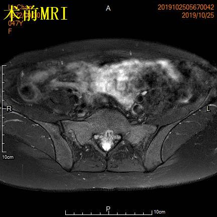 子宫腺肌症称为不死的癌症,子宫腺肌症是不死的癌症吗