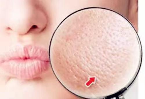 解决肌肤毛孔粗大有效方法,怎么解决皮肤毛孔粗大