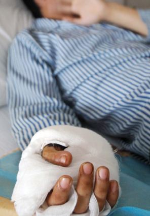 拇指再造术多少钱,拇指再造术哪里最强