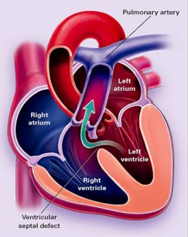 小孩子心脏没有闭合多大要做手术,小孩心脏没长拢做手术费用高吗