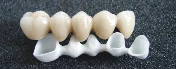 氧化锆全瓷牙的缺点和优点,牙医建议烤瓷不建议全瓷