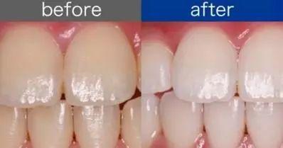 单眼皮怎么整容变双眼皮,嫌弃自己双眼皮小怎么办