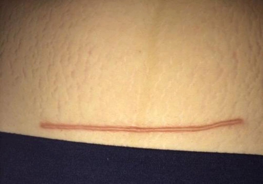 有条件顺产，千万别刨腹产！刨腹产比顺产好？骗人的！