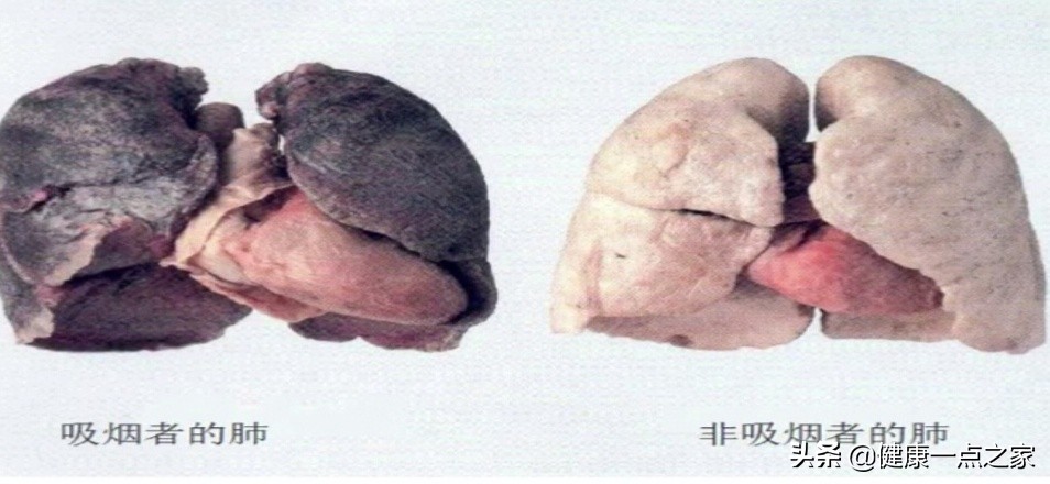 慢阻肺患者后期怎么护理,慢阻肺的护理要点及健康指导