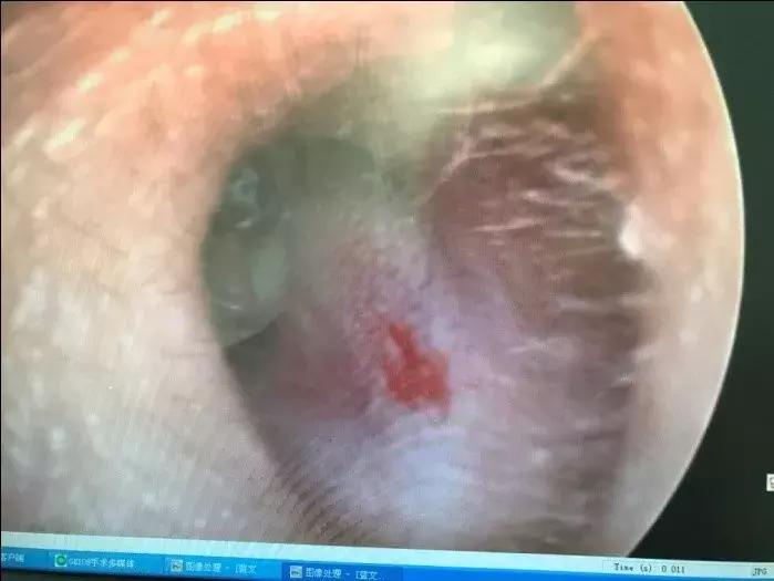 耳朵里长肉芽什么感觉,耳朵里长个小肉芽怎么办