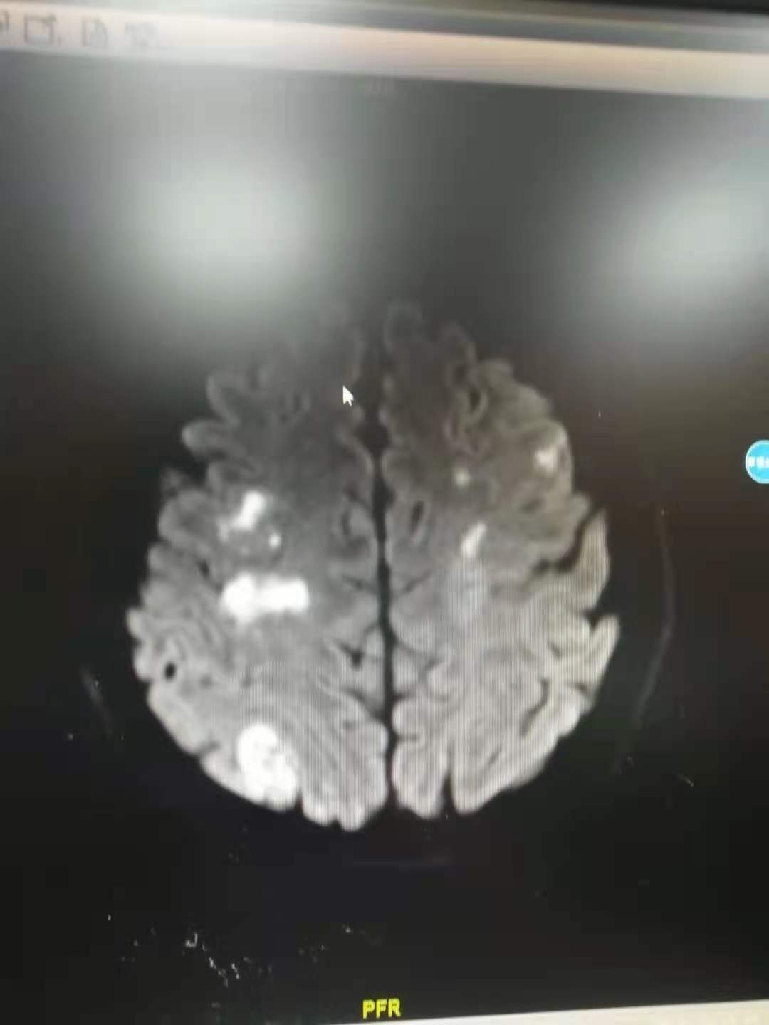 湖北20岁小伙感冒发烧,25岁小伙突然偏瘫