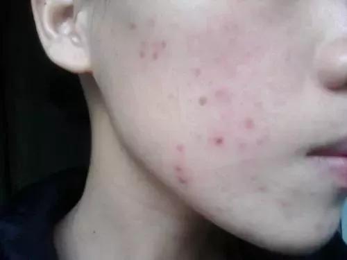 祛痘和祛痘印最有效的方法,祛痘印和祛痘坑哪个效果好