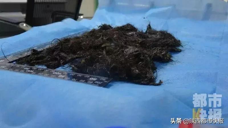 西安一女孩吃头发,86岁女童胃里取出2斤头发