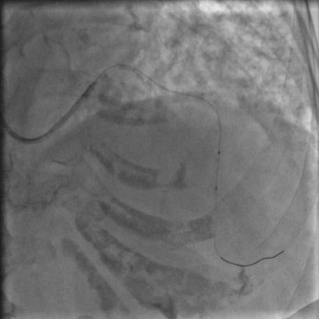 85岁老人心脏堵塞,77岁老人冠脉狭窄放支架还是搭桥