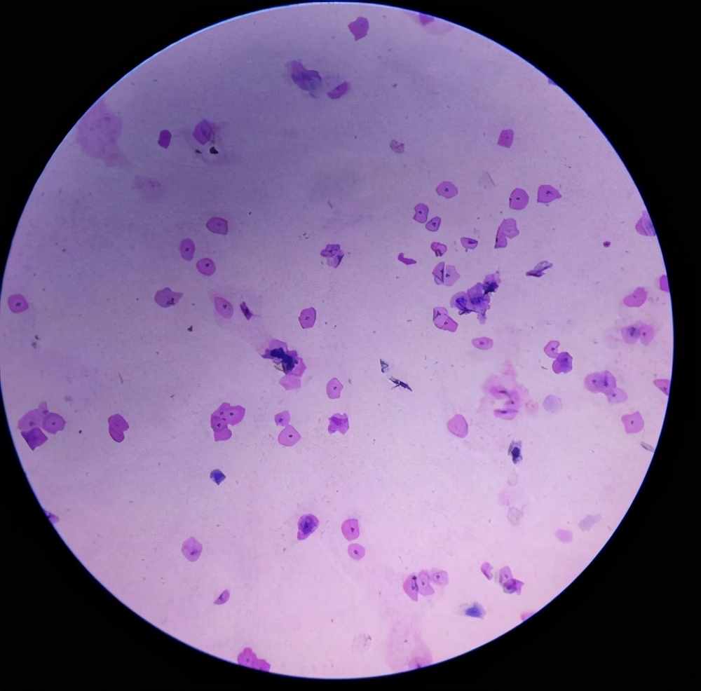 黏液表皮样癌是一种恶性肿瘤，侵犯面神经可引起腮腺的面神经麻痹