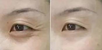 戚薇涂眼霜真的有效果吗,戚薇分享眼霜涂抹方法