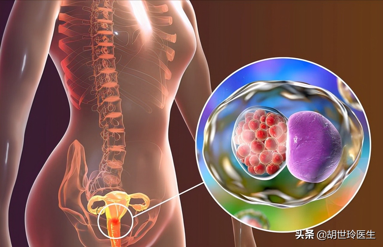 宫颈炎会怎么治疗,宫颈炎是什么怎么解决