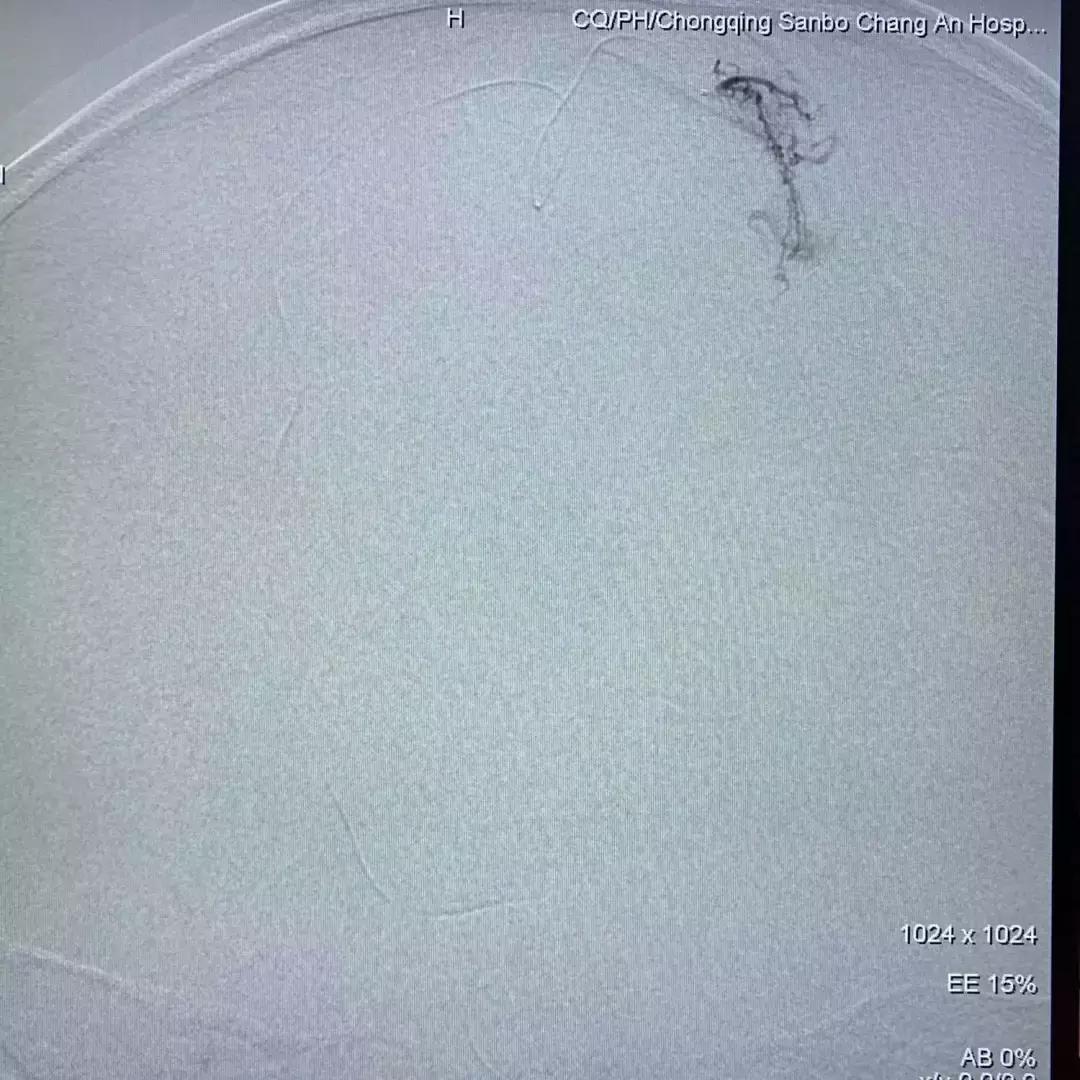 北京三博脑科医院康复治疗,北京三博脑科医院治脑血管瘤怎样