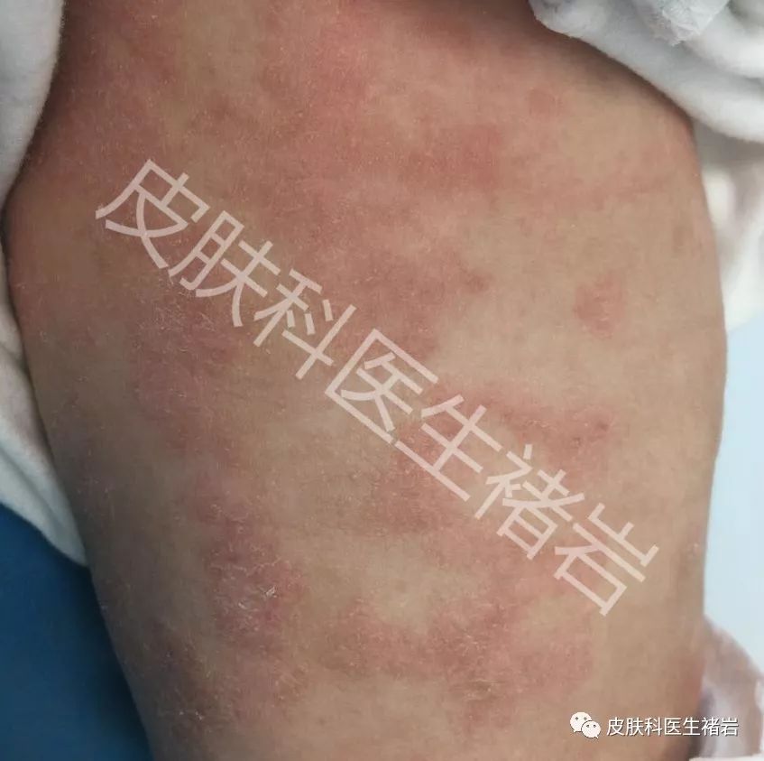 湿疹性皮炎长什么样,脸上湿疹长什么样