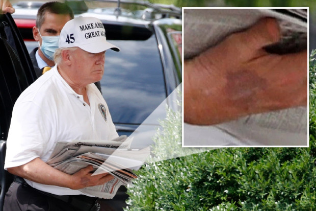 特朗普右手现大片瘀伤，坊间猜测他在秘密治病