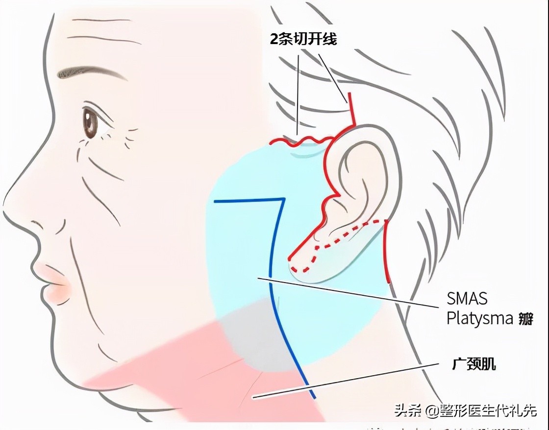 拉皮五天没消肿法令纹还在,拉皮手术可以去除法令纹吗