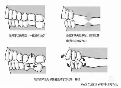 缺牙太久邻牙倾斜可以磨掉吗,缺牙太久导致旁边的牙倾斜了