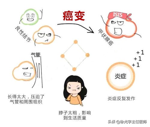 肝内结节的消除方法,徐光宇甲状腺结节二级