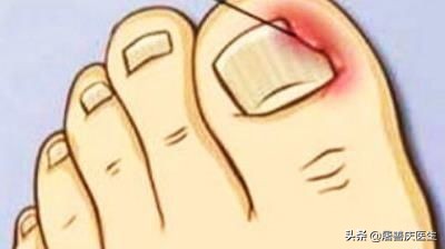 改掉啃手的习惯,拔肉刺引起甲沟炎