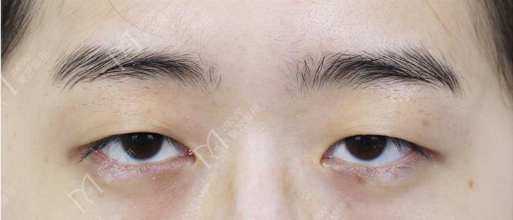 为什么有人割了双眼皮反而不好看,为啥有些人割了双眼皮变化巨大