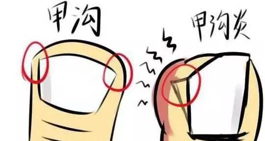 指甲随便剪，小心剪出甲沟炎！