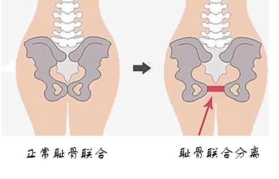 怀孕骨头痛是什么原因,怀孕胸下面骨头疼是怎么回事啊