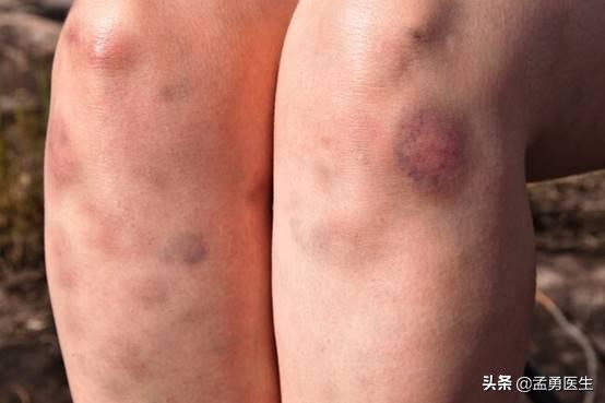 当你缺少蛋白质,身体缺乏的10种营养