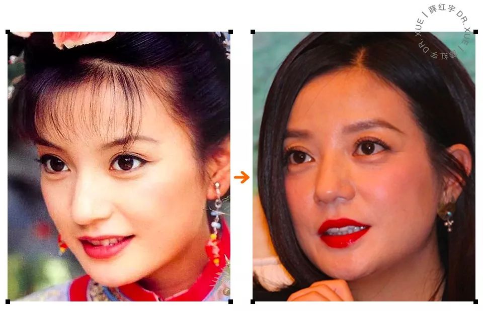 三层眼皮女人的特点,哪种眼皮最好看