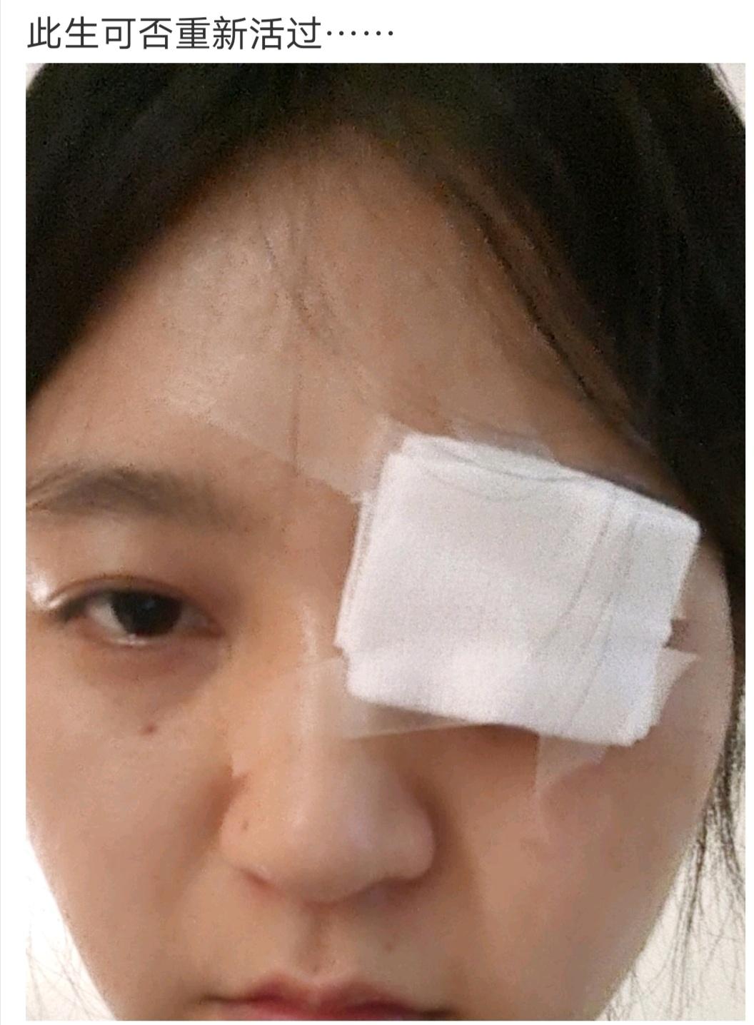 被热油烫到眼睛,被烫过的眼睛