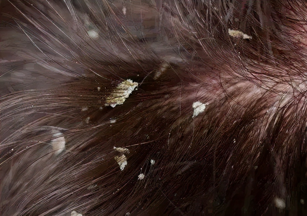头皮屑严重如何处理好得快,头皮屑是怎么造成的如何治好