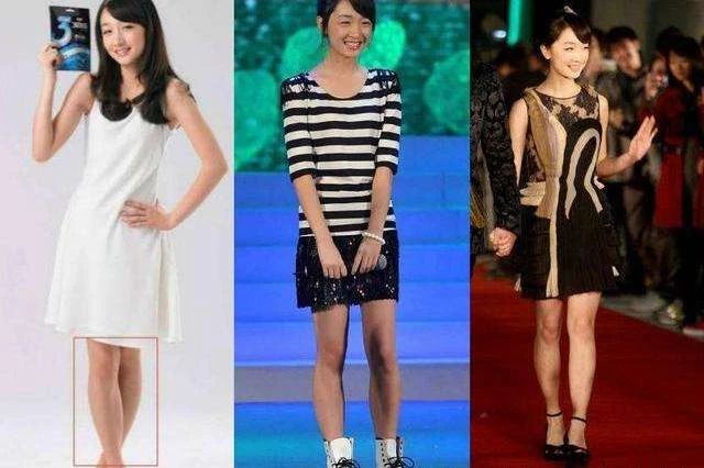 小腿肌肉外翻骨头是弯的,小腿外翻有明显的肌肉腿怎么办