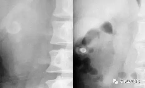 腹部平片能看到结石吗,腹部高密度结节影是什么