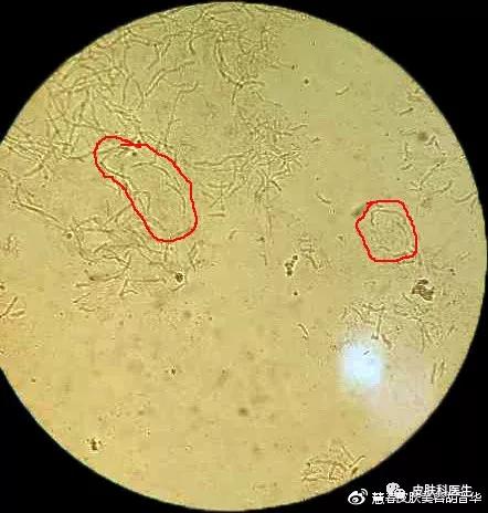 是不是皮肤癣，皮肤真菌镜检来告诉你！