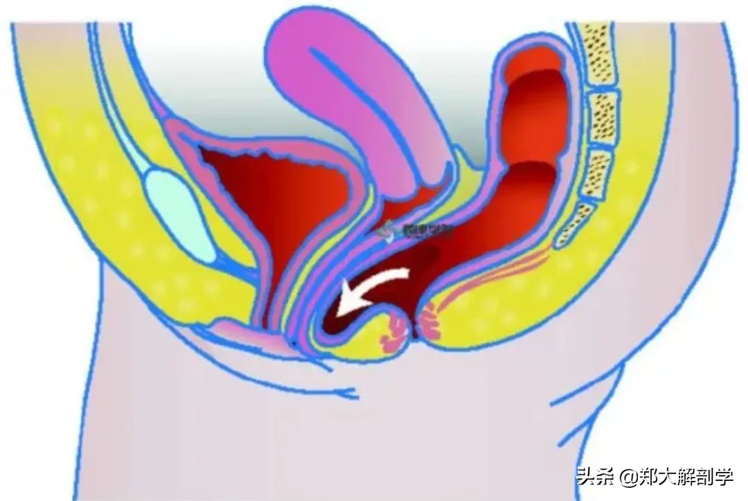女性盆底功能障碍性疾病表现,盆底功能障碍会引起失眠吗