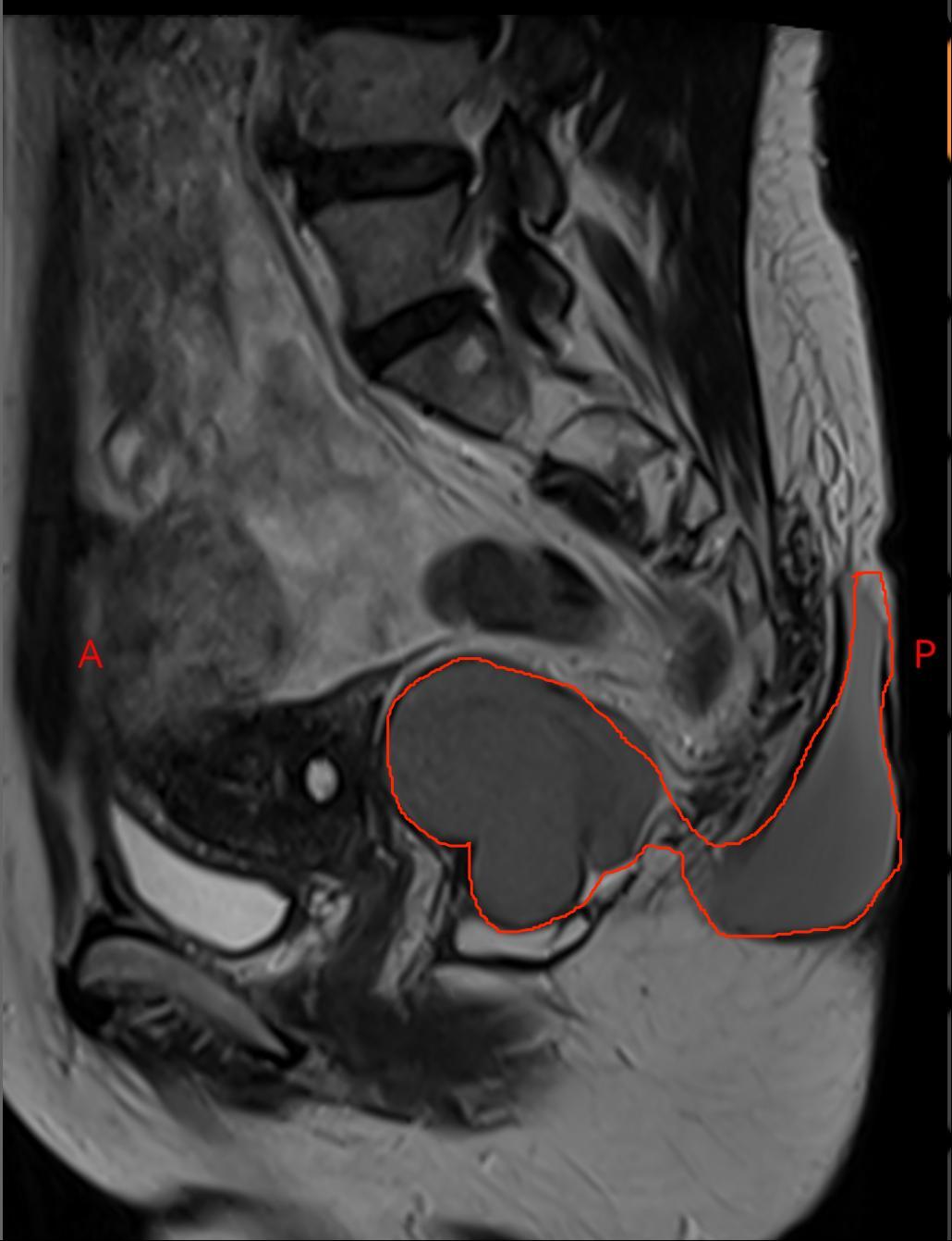 臀部上长个瘤子不疼不痒软软的,臀部上长一椭圆形不痛不痒的瘤子
